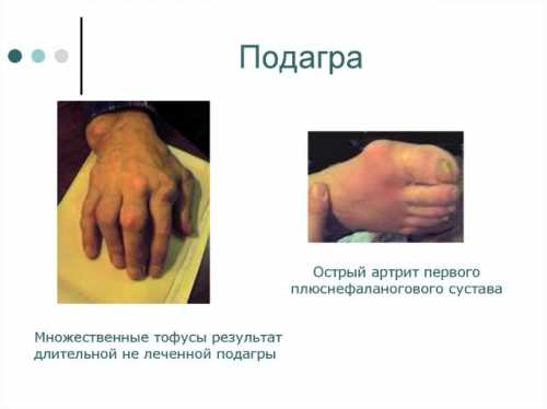 тубоотит: причины заболевания, формы болезни, диагностика, лечение